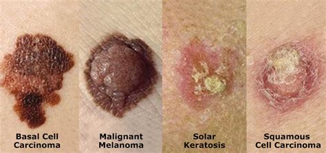 What Does Skin Cancer Look Like Anyway Healthy Delaware