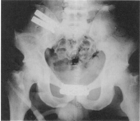 postoperative pelvic radiograph showing plate fixation of the symphysis download scientific