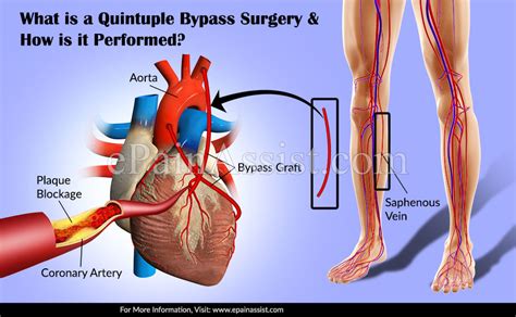 What Is A Quintuple Bypass Surgery And How Is It Performed