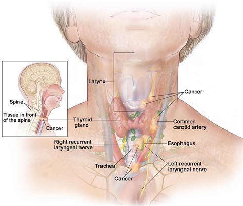 Hurthle Cell Carcinoma Causes Symptoms Diagnosis Treatment
