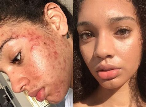 This Viral All Natural Acne Cure Completely Cleared This Models Skin