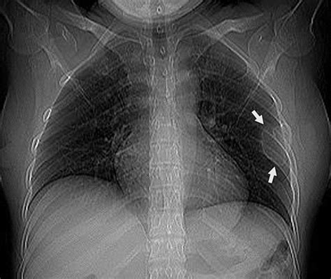 Fibrous Dysplasia Of The Rib Airp Best Cases In Radiologic Pathologic