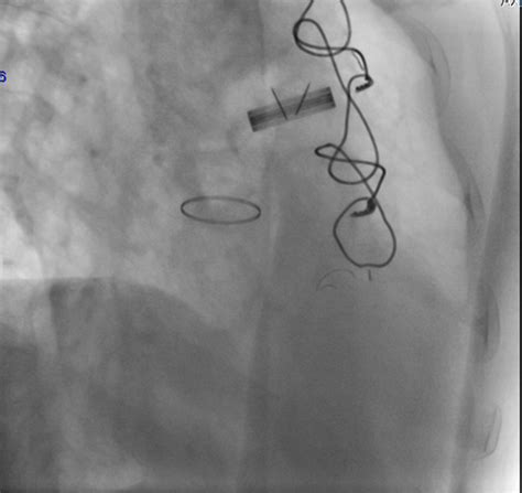 First Fluoroscopy Notes Normal Motion In Prosthetic Aortic Valve