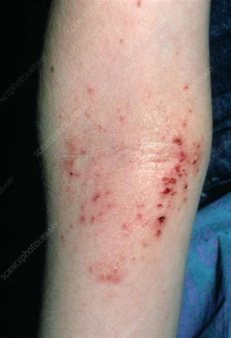 Atopic Eczema In Crook Of The Elbow Stock Image M1500117 Science