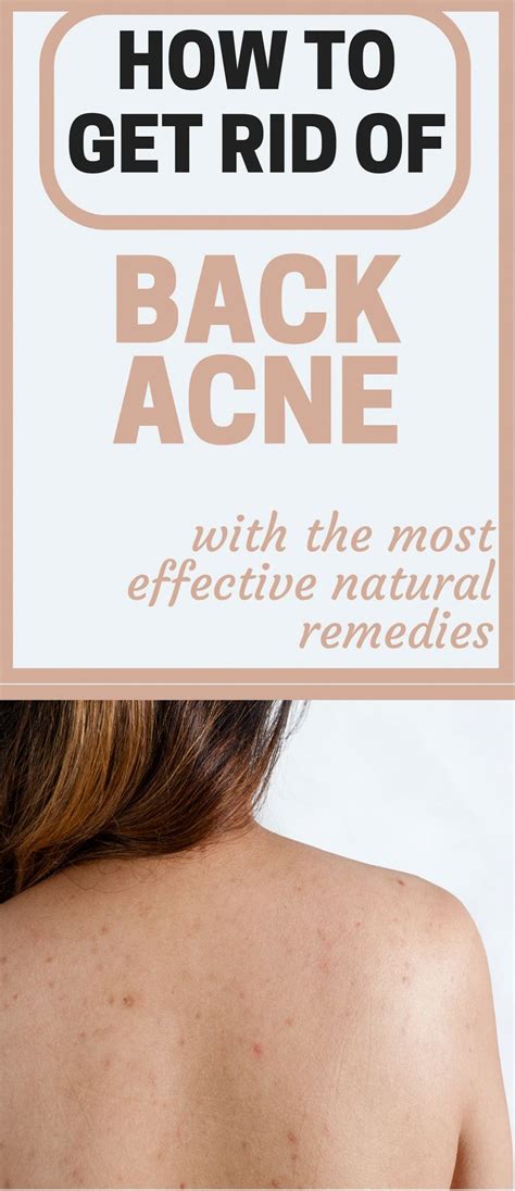 How To Get Rid Of Back Acne With The Most Effective Natural Remedies