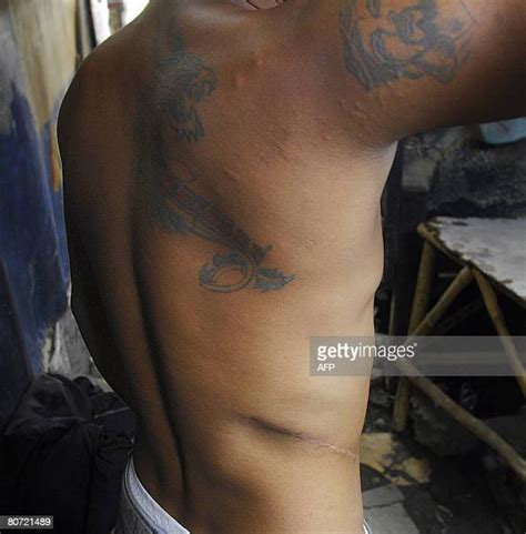 Kidney Scar Photos And Premium High Res Pictures Getty Images
