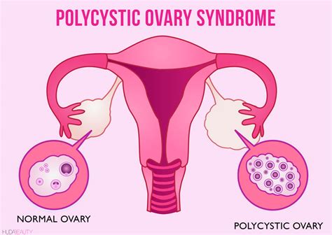 everything you need to know about polycystic ovaries blog huda beauty