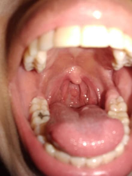 Roncha o bulto en mi garganta - Foro Otorrinolaringología (nariz