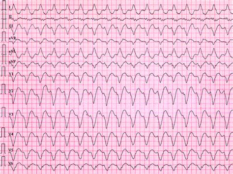 Unusual Wide Complex Tachycardia During Rhythm Control For Atrial