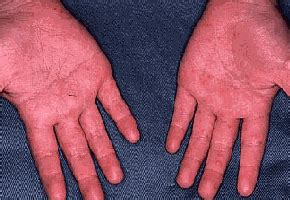 手足口病の症状