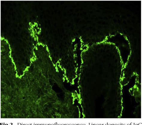 Figure 2 From Levetiracetam Induced Bullous Pemphigoid In A Young Adult