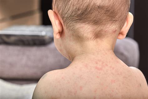 Roseola In Toddlers Causes Symptoms And Treatment Being The Parent