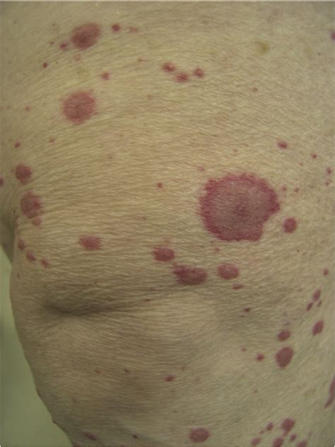 Shape And Configuration Of Skin Lesions Targetoid Lesions Clinics In