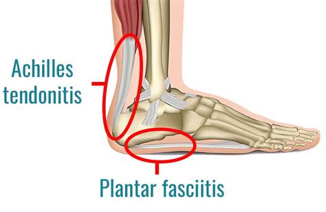 Achilles Tendonitis Vs Plantar Fasciitis How To Tell The Difference 13467 The Best Porn Website