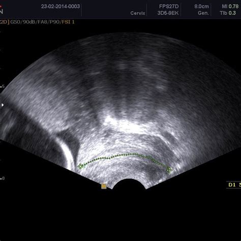 transabdominal ultrasound assessment of cervical length download