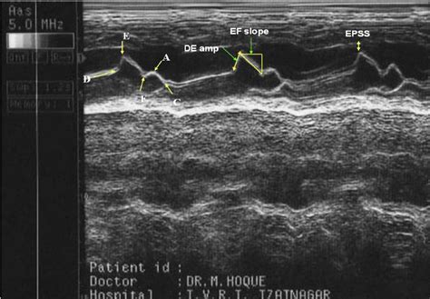 Marking Of Mitral Valve Leaflets On M Mode Echocardiogram D Point