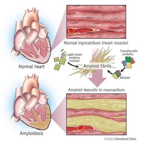 Cardiac Amyloidosis Causes Symptoms And Treatment