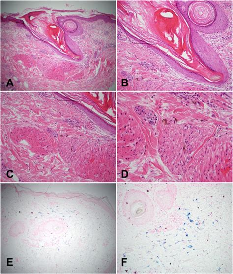 Keratosis Pilaris With Adjacent Haemosiderin Deposition A Clue To