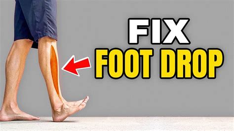 3 Exercises To Correct Foot Drop Fastestwellness