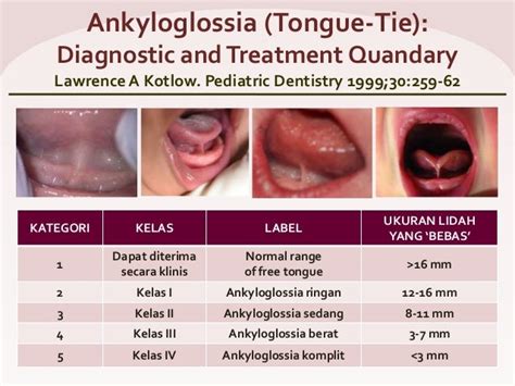 Diagnosis Tongue Tie And Indikasi Frenektomi