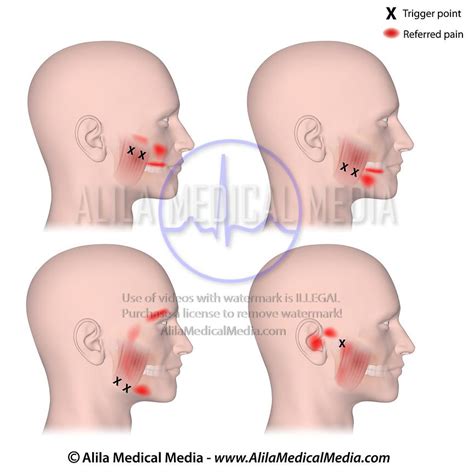 Alila Medical Media Trigger Points And Referred Pain Of The Masseters Medical Illustration