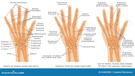 Types Of Fracture Fracture Bone Set Infographics Vector Illustration