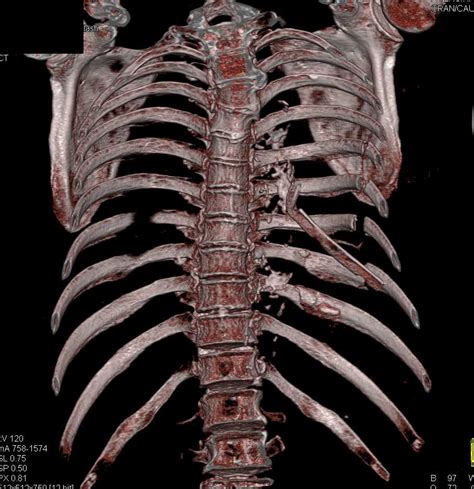 Trauma With Multiple Left Rib Fractures And Pulmonary Contusion