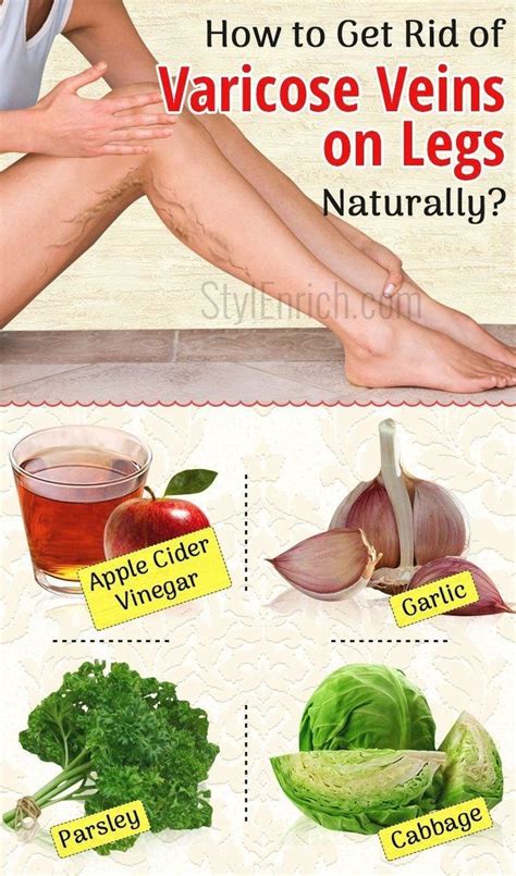 Pin On Remedies For Varicose Veins