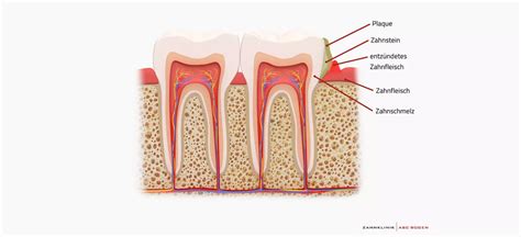 Zahnfleischentz Ndung Gingivitis Ursachen Symptome Therapie