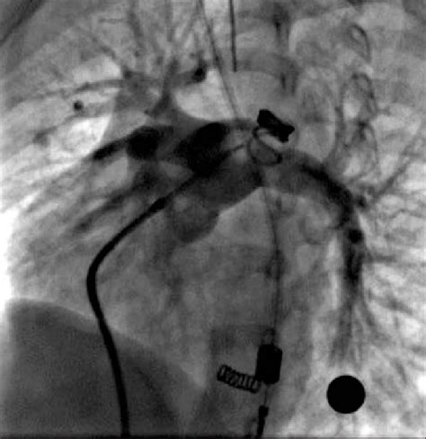 Angiografia No Tronco Da Artéria Pulmonar Em Projeção Oblíqua Anterior