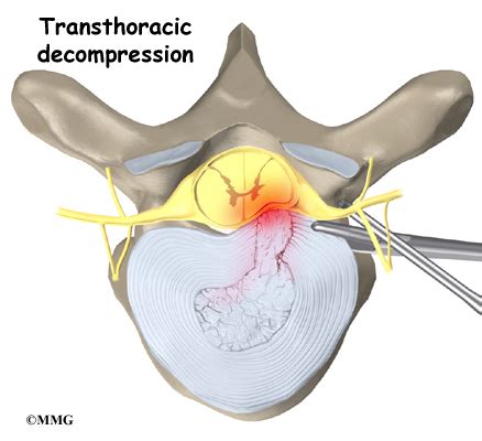 In most cases herniated discs occur in the lumbar spine (lower back), or the cervical spine (neck), and to a lesser extent they can also occur in the thoracic (upper back). Thoracic Disc Herniation | eOrthopod.com