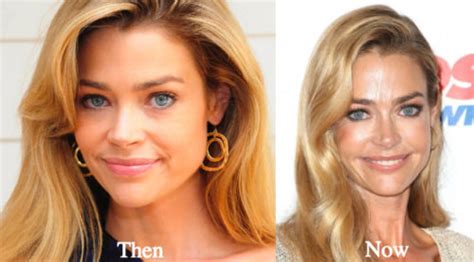 Denise Richards Plastic Surgery Before And After Photos Latest