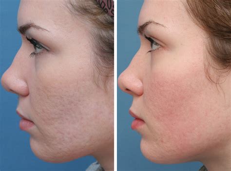 Acne Scar Treatment In Indore At Shreyas Allskin Clinic In Indore India
