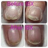 Images of Weak Nail Repair