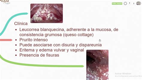 Candidiasis Vaginal Signos Y S Ntomas Diagn Stico Hot Sex Picture