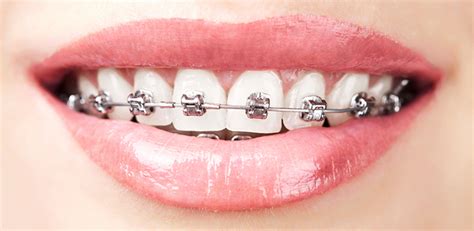 How Much Do Braces Cost Splash Orthodontics