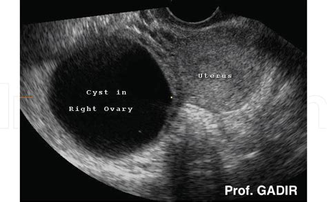 √ Ovarian Cancer Ultrasound Ovarian Cyst Transvaginal Ultrasonography