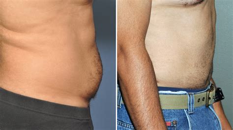 Male Abdominal Liposuction Result Side View Dr Barry Eppley