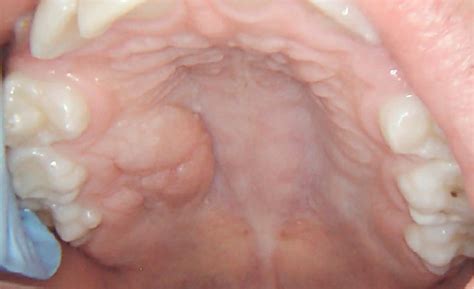 A Well Circumscribed Lobulated Tumor On The Hard Palatal Mucosa In A
