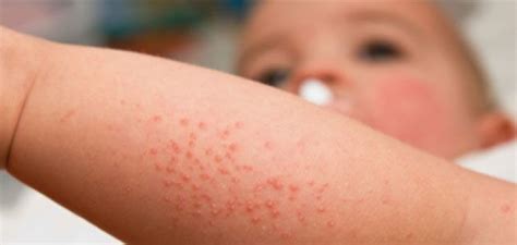 Skin Rash 101 How To Identify Them — Elevated Health