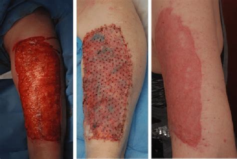 Preoperative Multiple Upper Arm Self Harm Scars Similar Scars Are