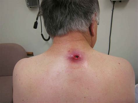 Sebaceous Cyst Type Causes Diagnosis And Treatment Health Digest
