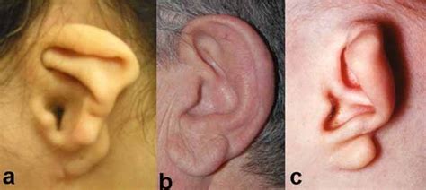 Auriculo Condylar Syndrome Medlineplus Genetics