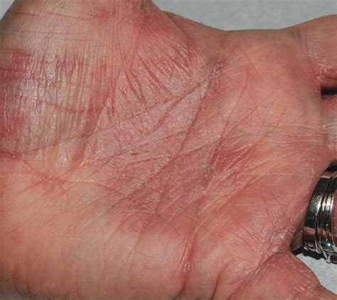 What Is The Cause Of This Womans Hand Rash Consultant360