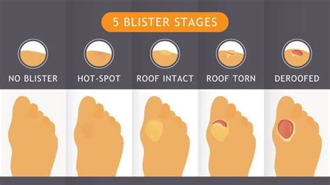 How To Treat A Blister — Scouterlife