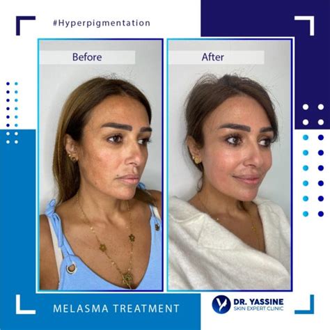 Melasma Causes And Treatments Dr Yassine Skin Expert Clinic