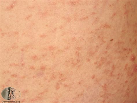 What Is A Scabies Rash Scabies Home Remedies