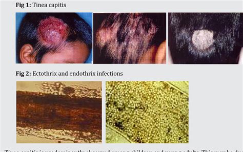Figure 2 From Fungal Infections Mycoses Dermatophytoses Tinea