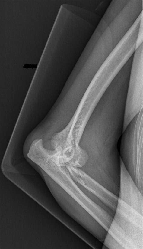 Elbow Dislocation Trauma Orthobullets