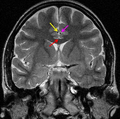 Brain Mri Dark Spots On Brain Mri